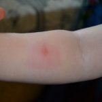 Проявления местной и общей аллергической реакции на укусы комаров