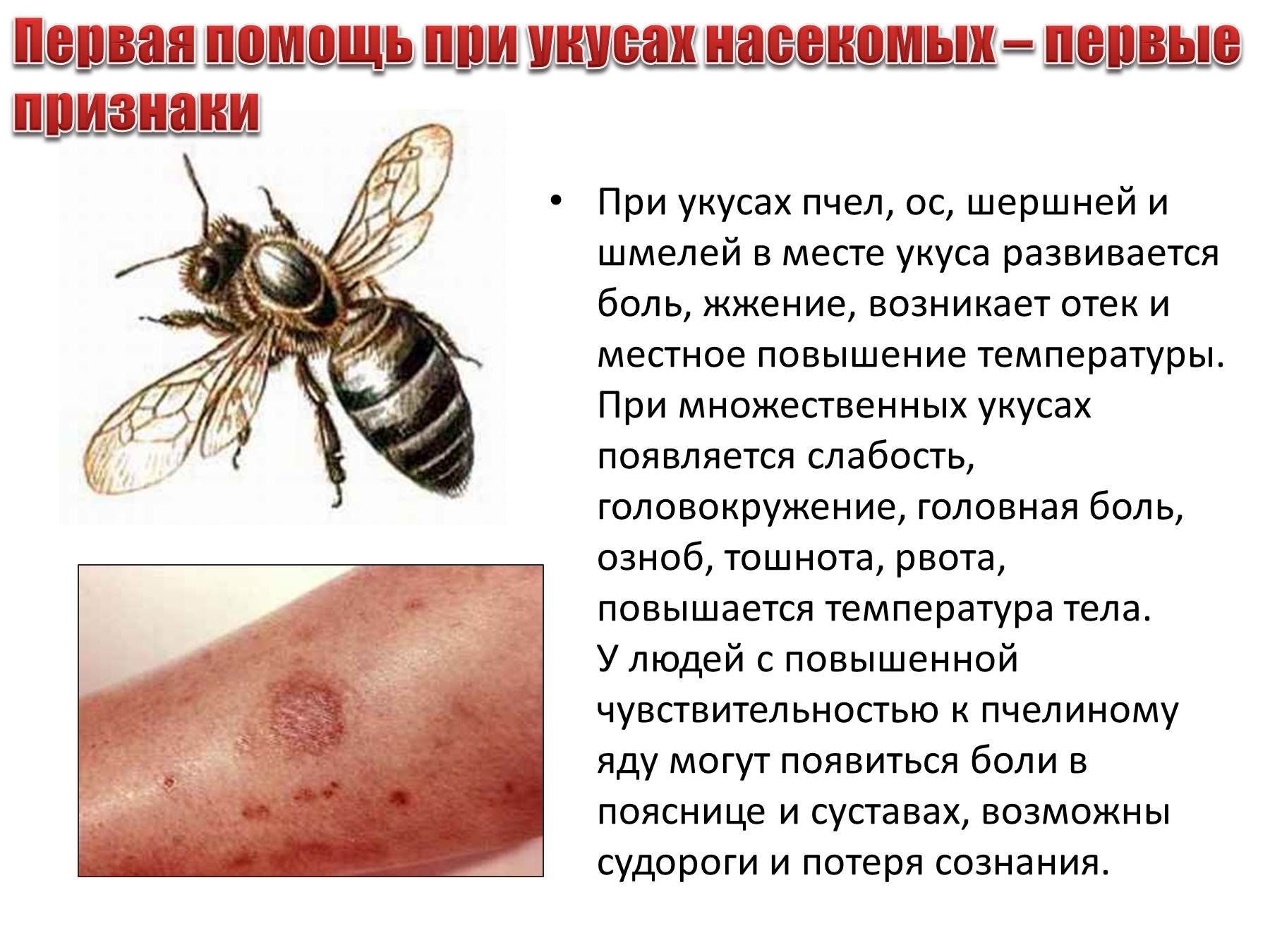 Укусы насекомых помочь. Симптомы при укусе пчелы.