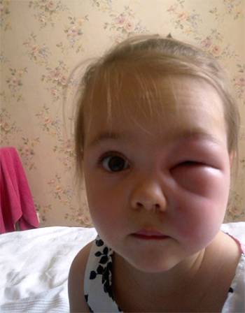 девочку укусила оса около глаза